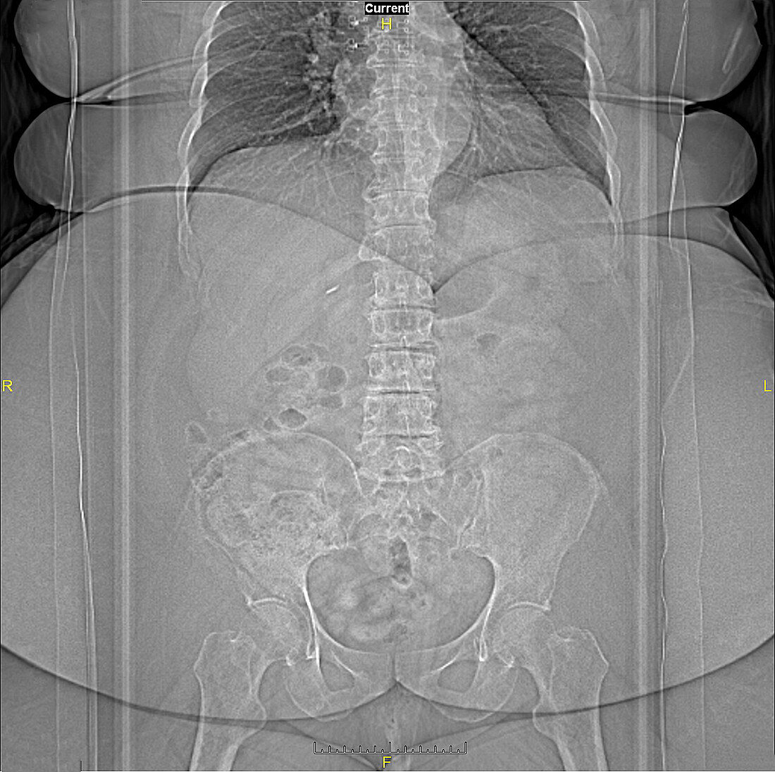Obese abdomen, CT scan