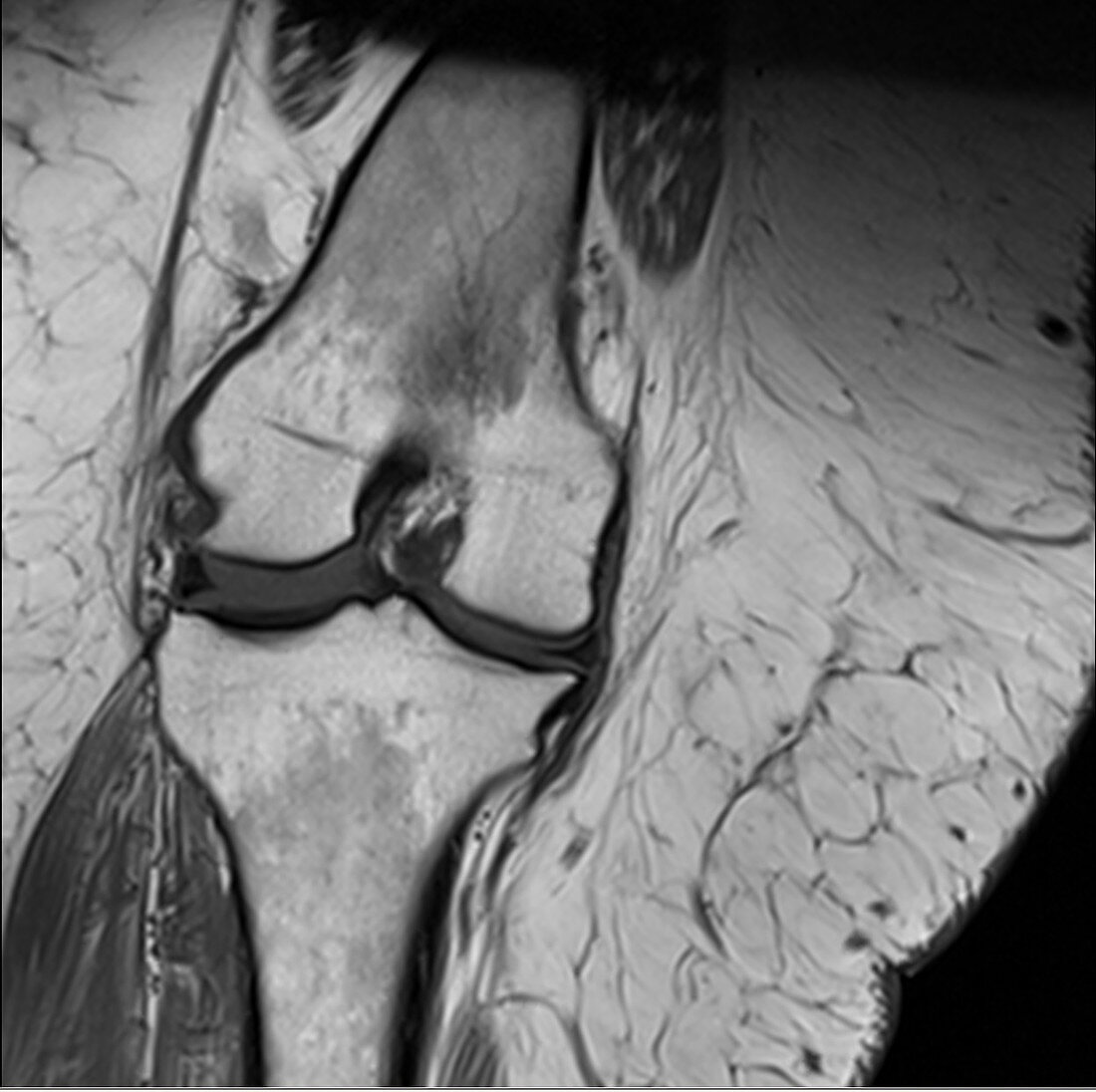 Obese knee, MRI