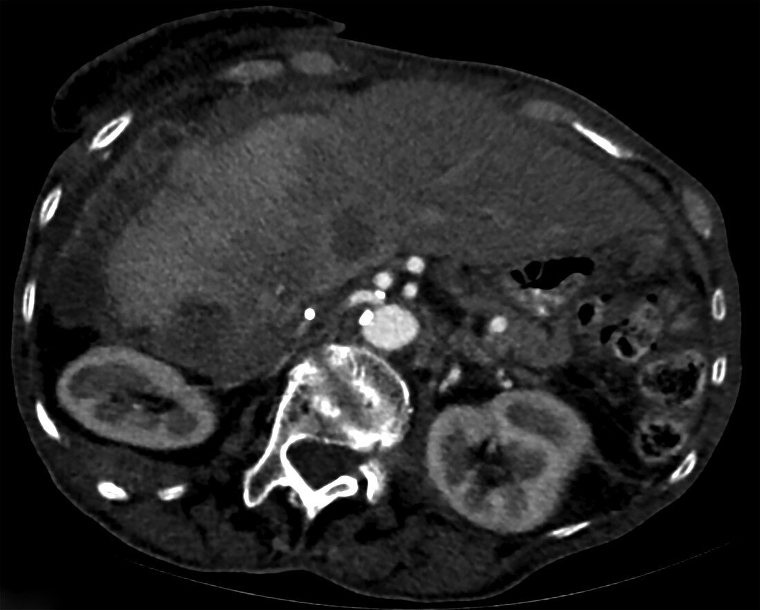 Metastatic ovarian carcinoma, CT scan