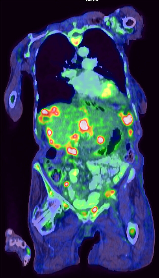 Metastatic ovarian carcinoma, PET CT scan