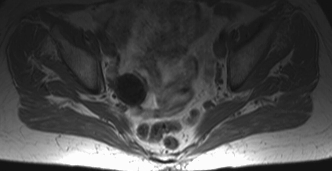 Ovarian cyst, MRI