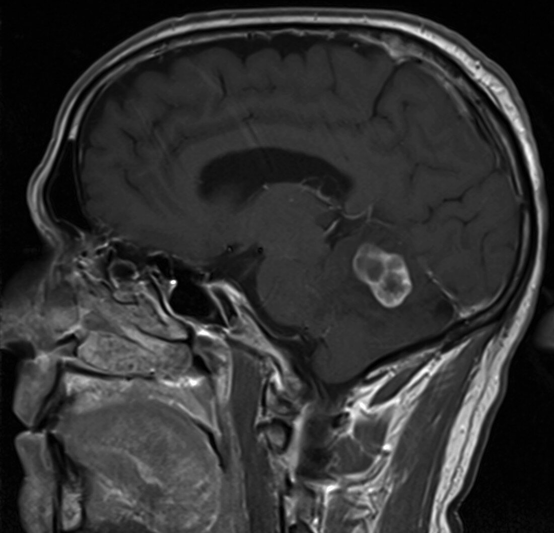 Metastatic renal cell carcinoma, brain, MRI