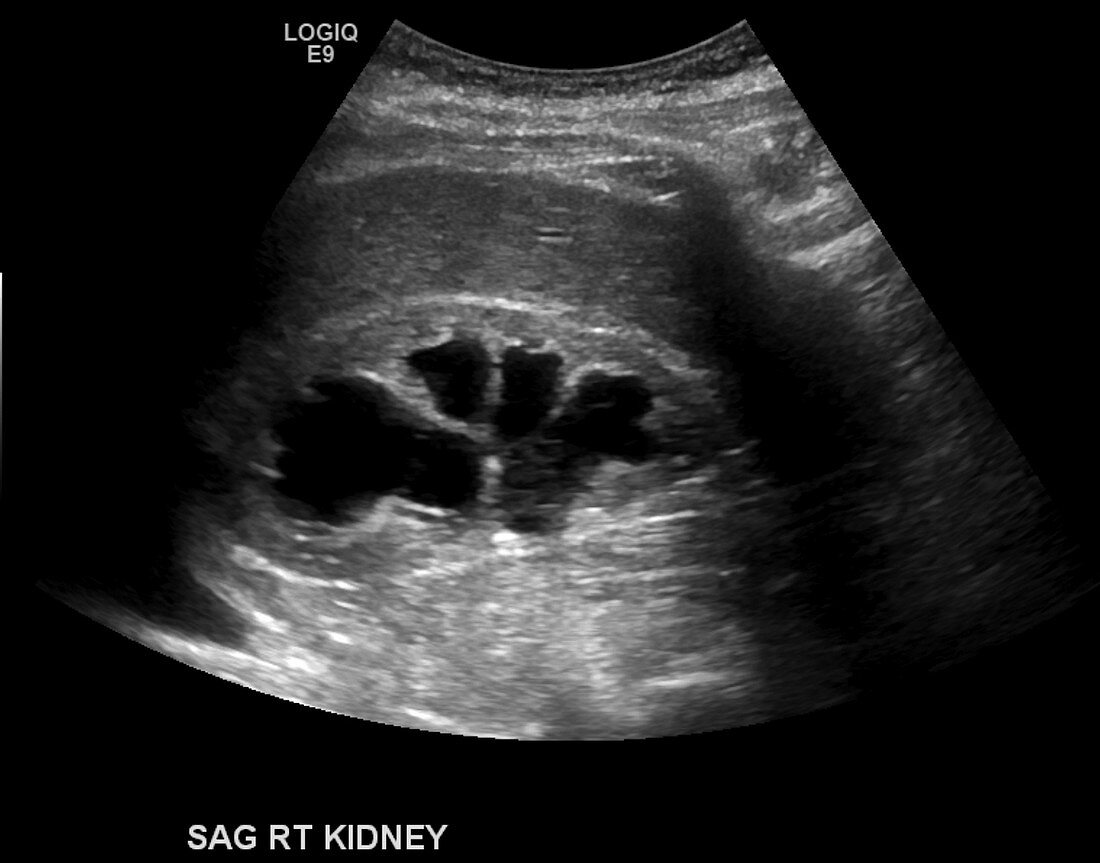 Hydronephrosis, ultrasound