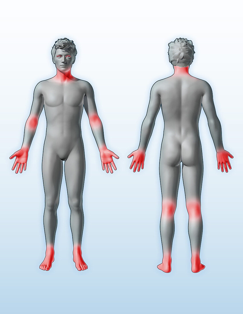 Atopic Dermatitis Locations, illustration