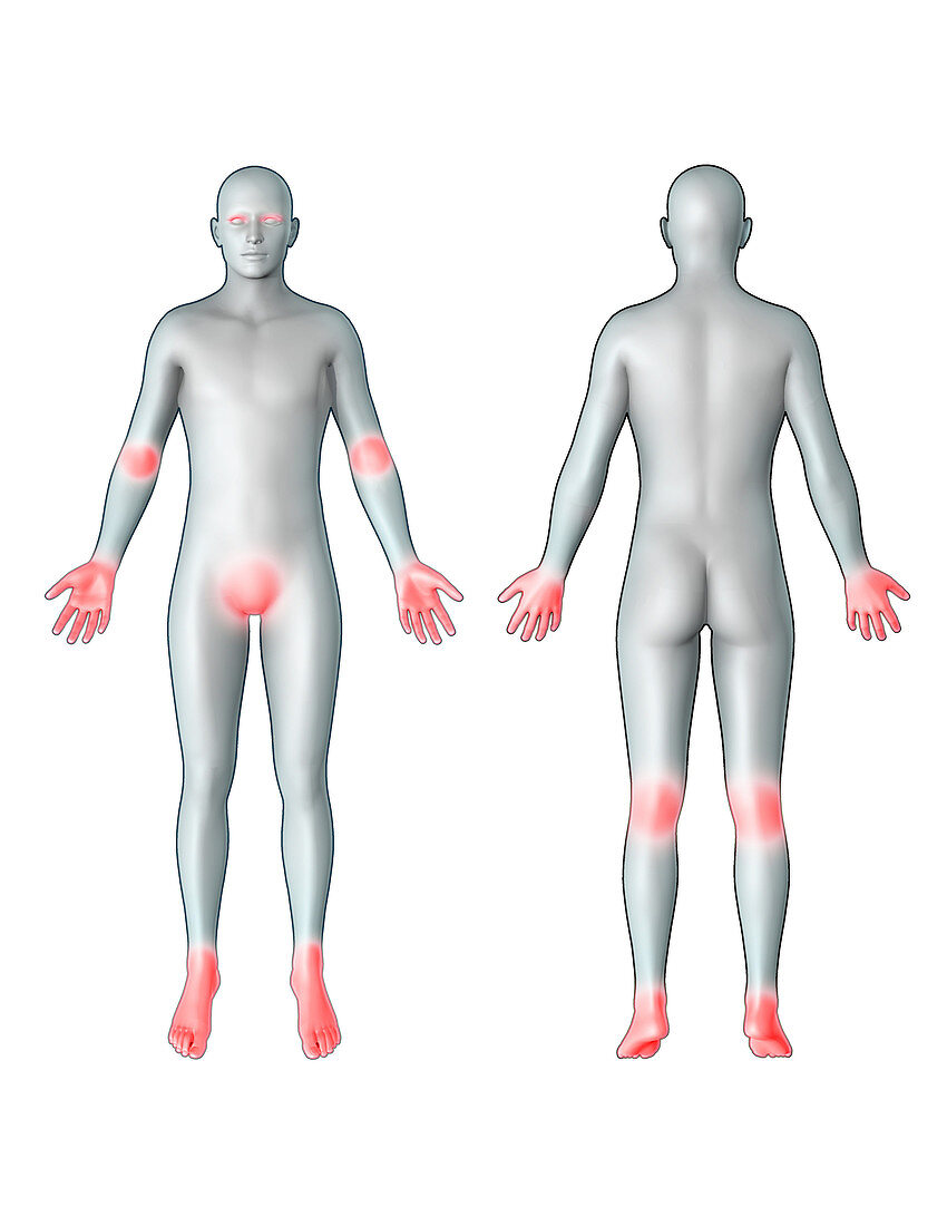 Atopic Dermatitis Locations, illustration