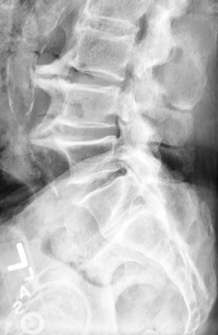 Large Bone Spurs Lumbar Spine, X-Ray