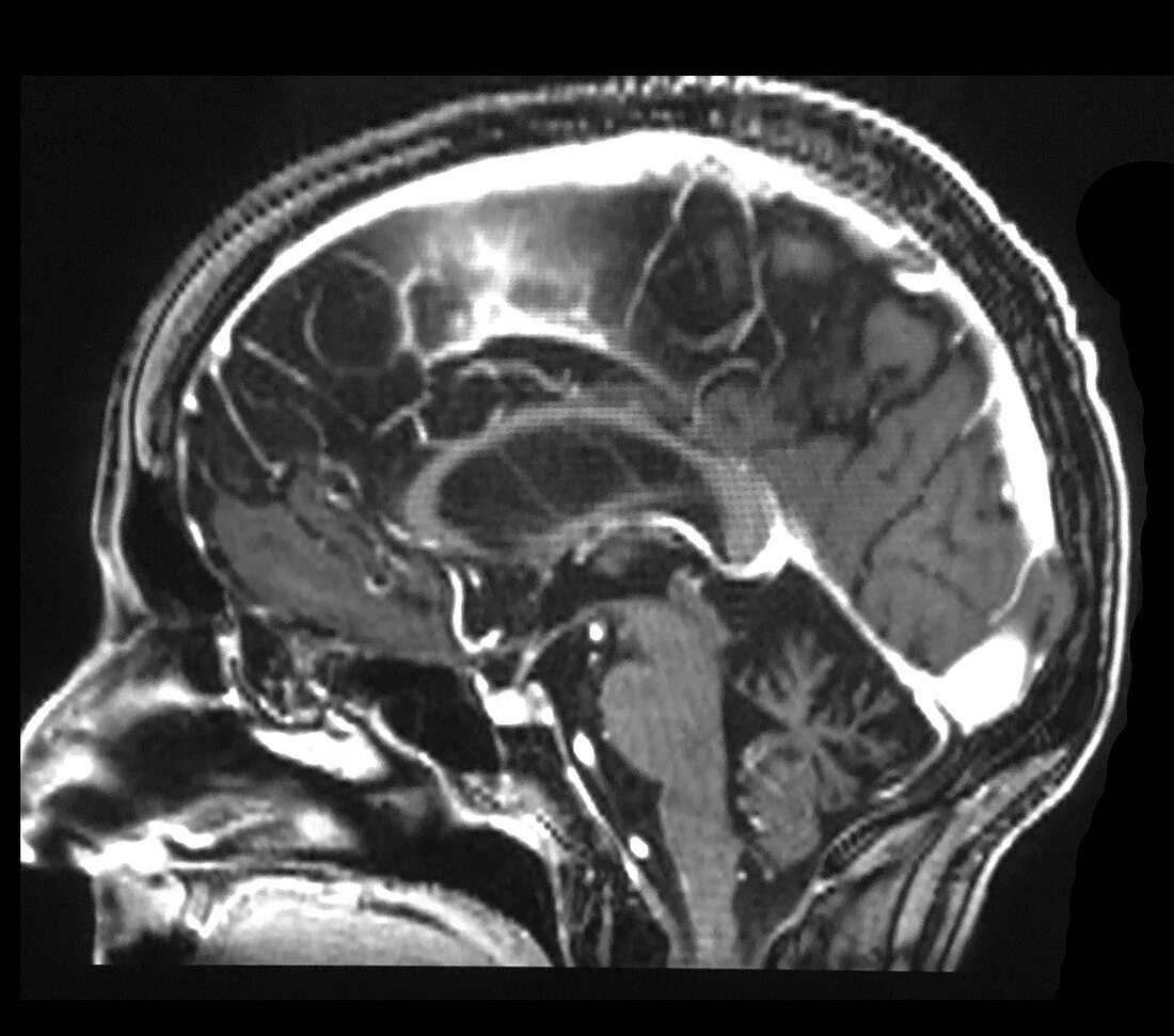 Severe Cerebellar Atrophy, MRI