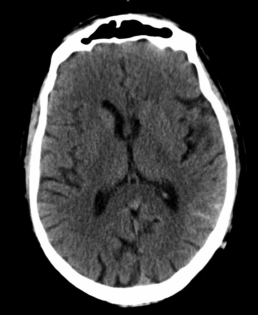 Subarachnoid haemorrhage, CT scan