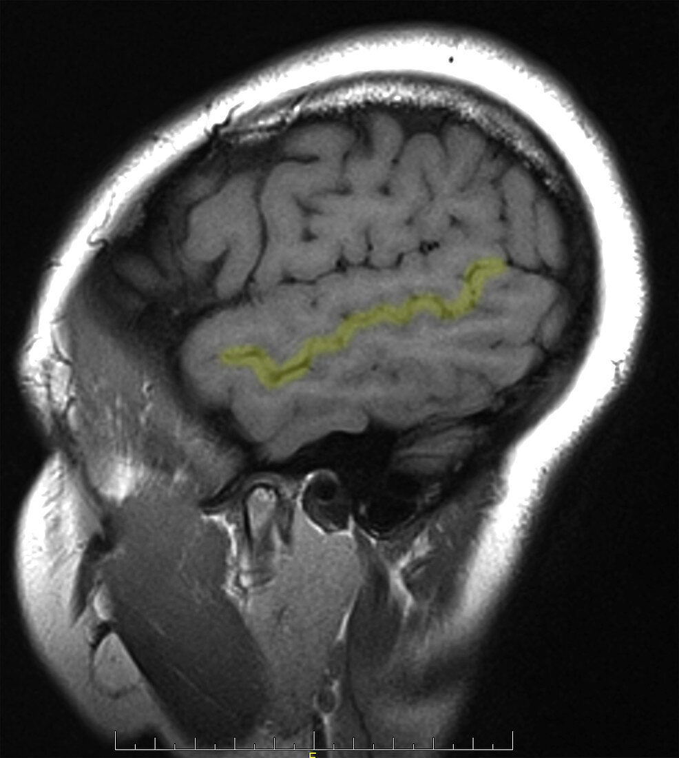 Superior temporal sulcus, highlighted, MRI
