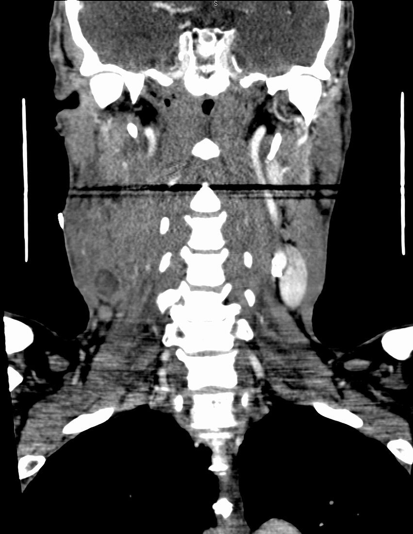 Tongue cancer, CT scan