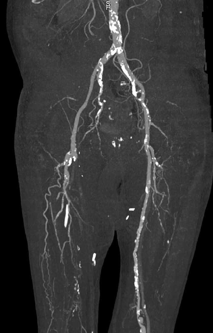 Abdominal aorta, calcification, CT angiography