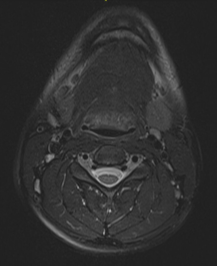 Normal neck and cervical spine, MRI