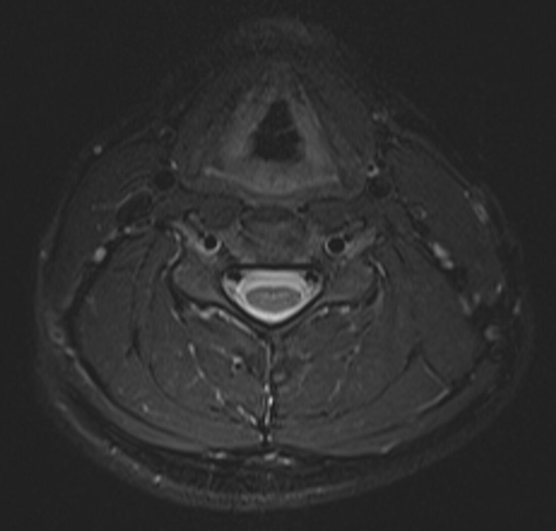 Normal neck and cervical spine, MRI