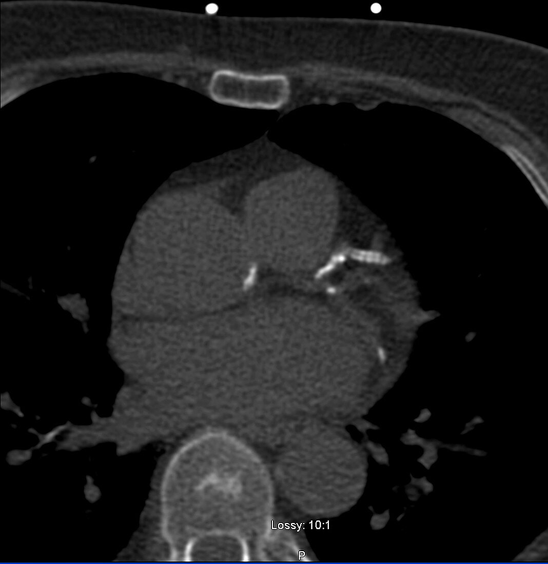 Artherosclerotic calcification of artery, CT scan