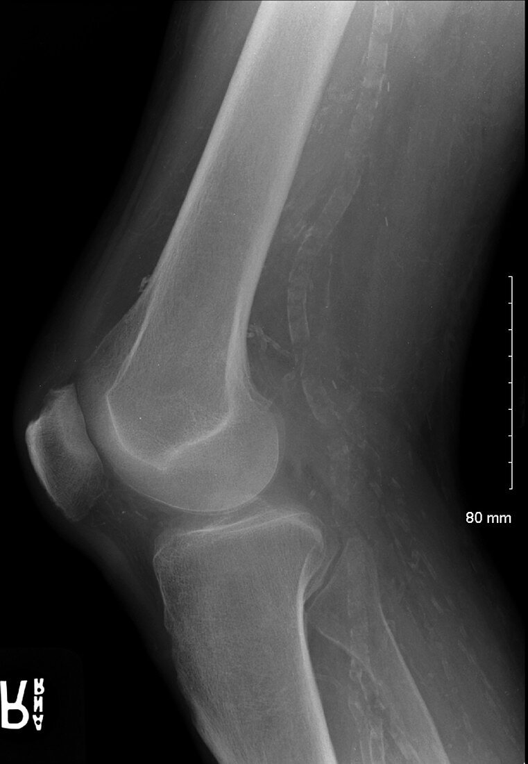 Vascular calcifications in knee, X-ray