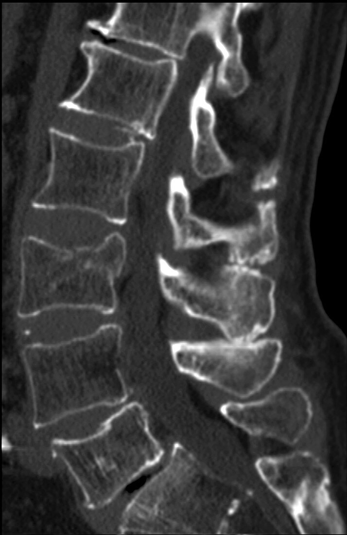 Acute compression fracture of L3, CT scan