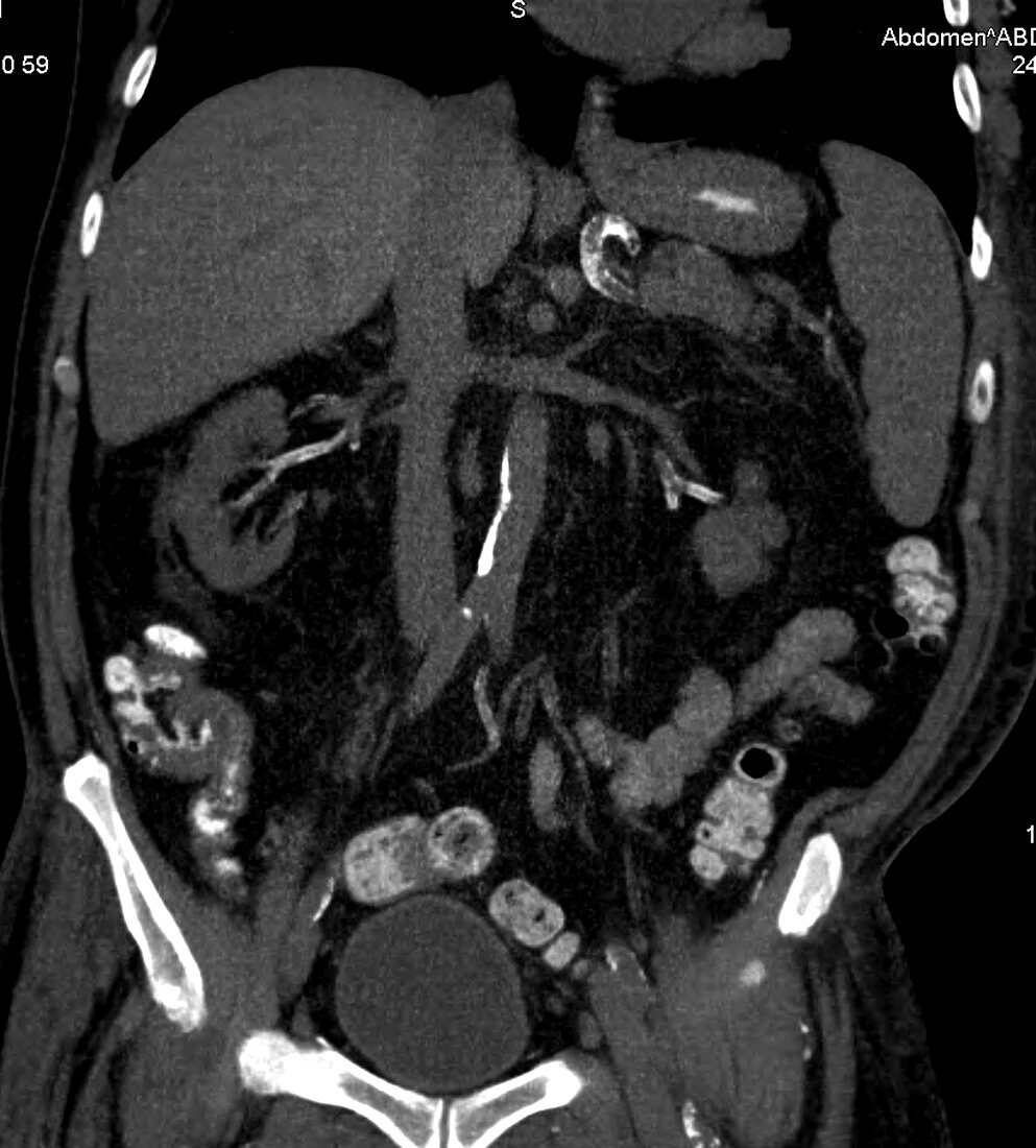 Calcification of renal arteries, aorta, CT scan