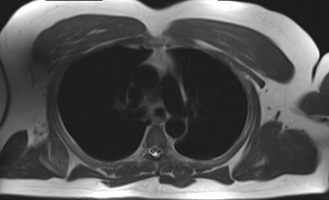 Normal chest and thoracic spine, MRI