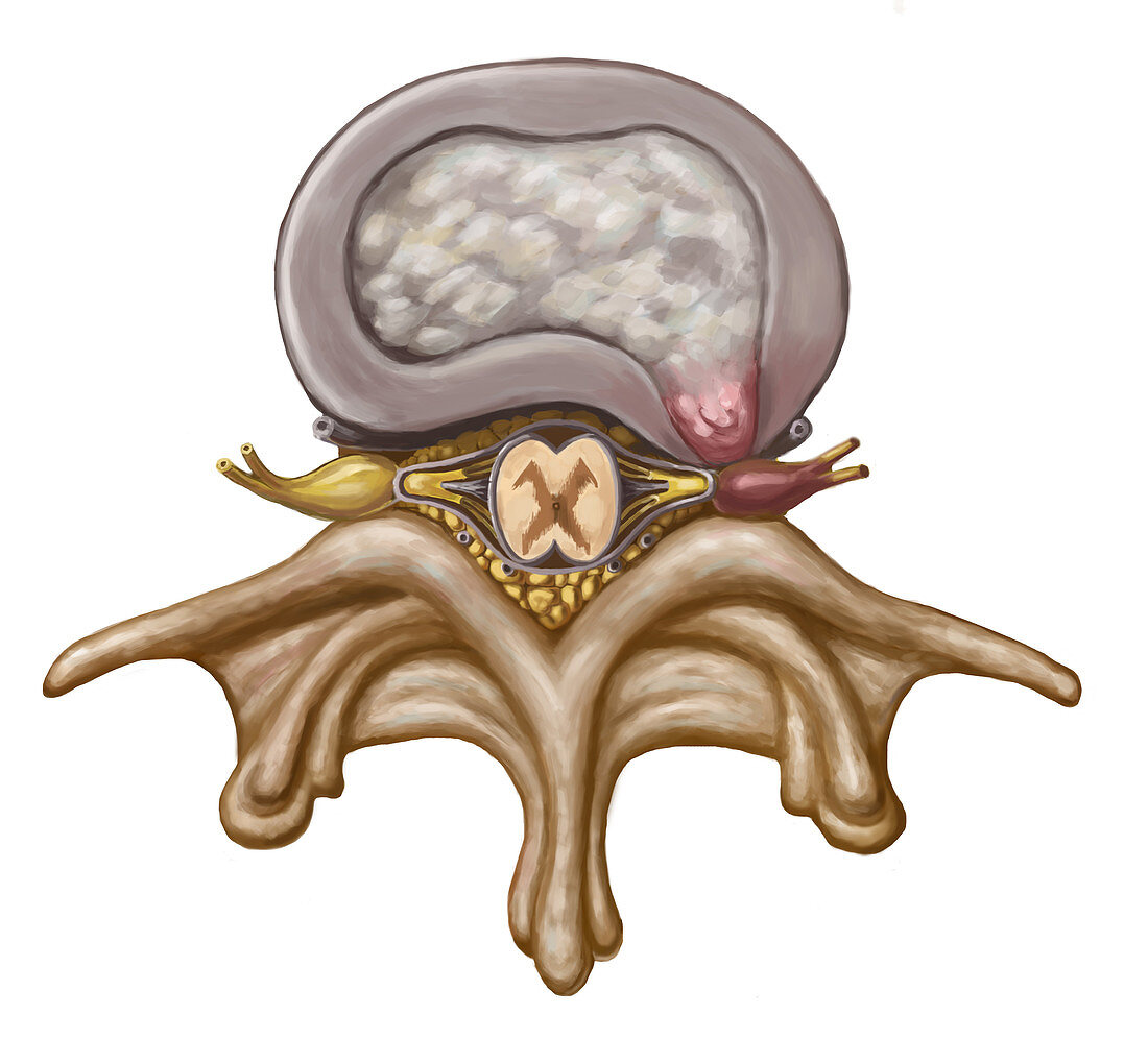 Herniated Disk, illustration