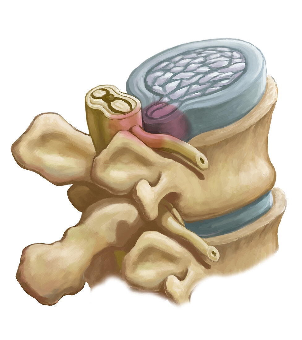 Herniated Disk, illustration