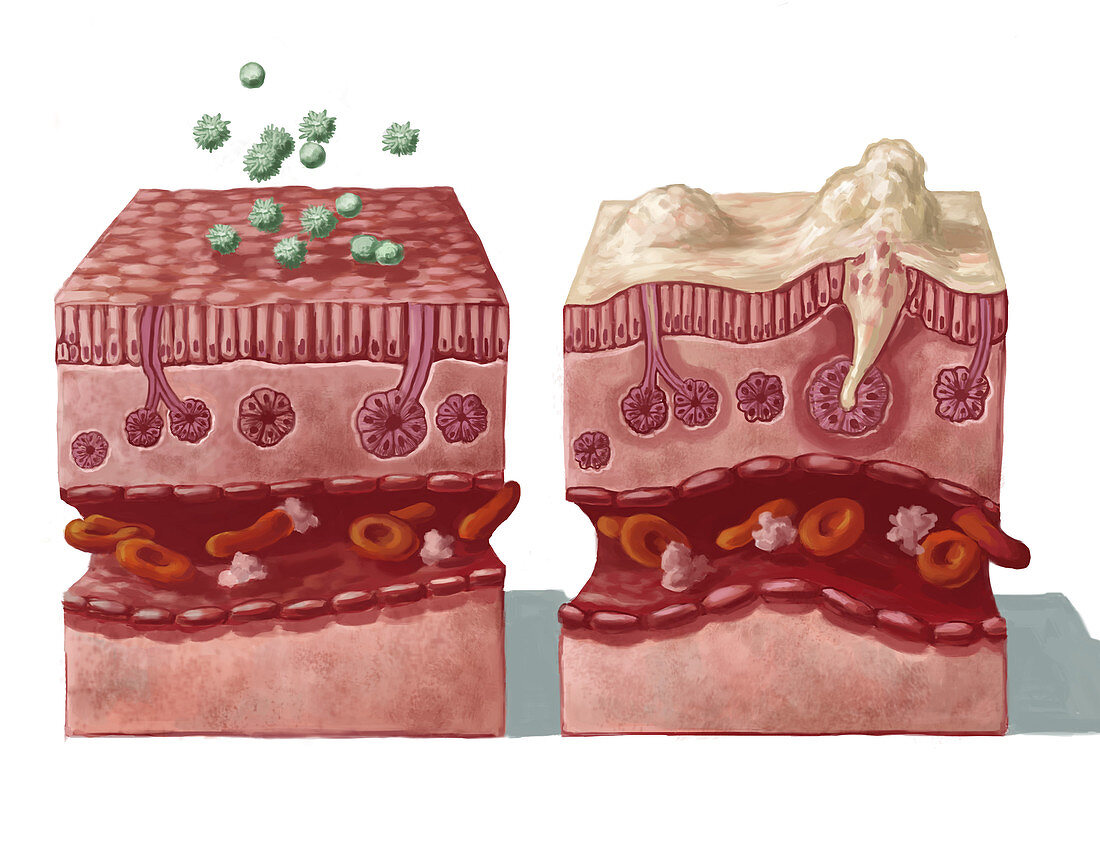 Mucous Reaction to Allergens, illustration