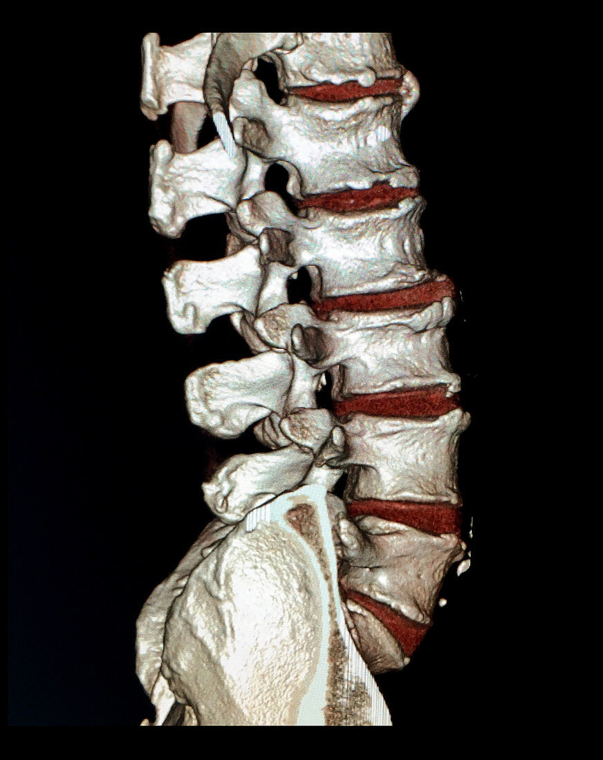 Reconstruction of Lumbar Spine, 3D CT