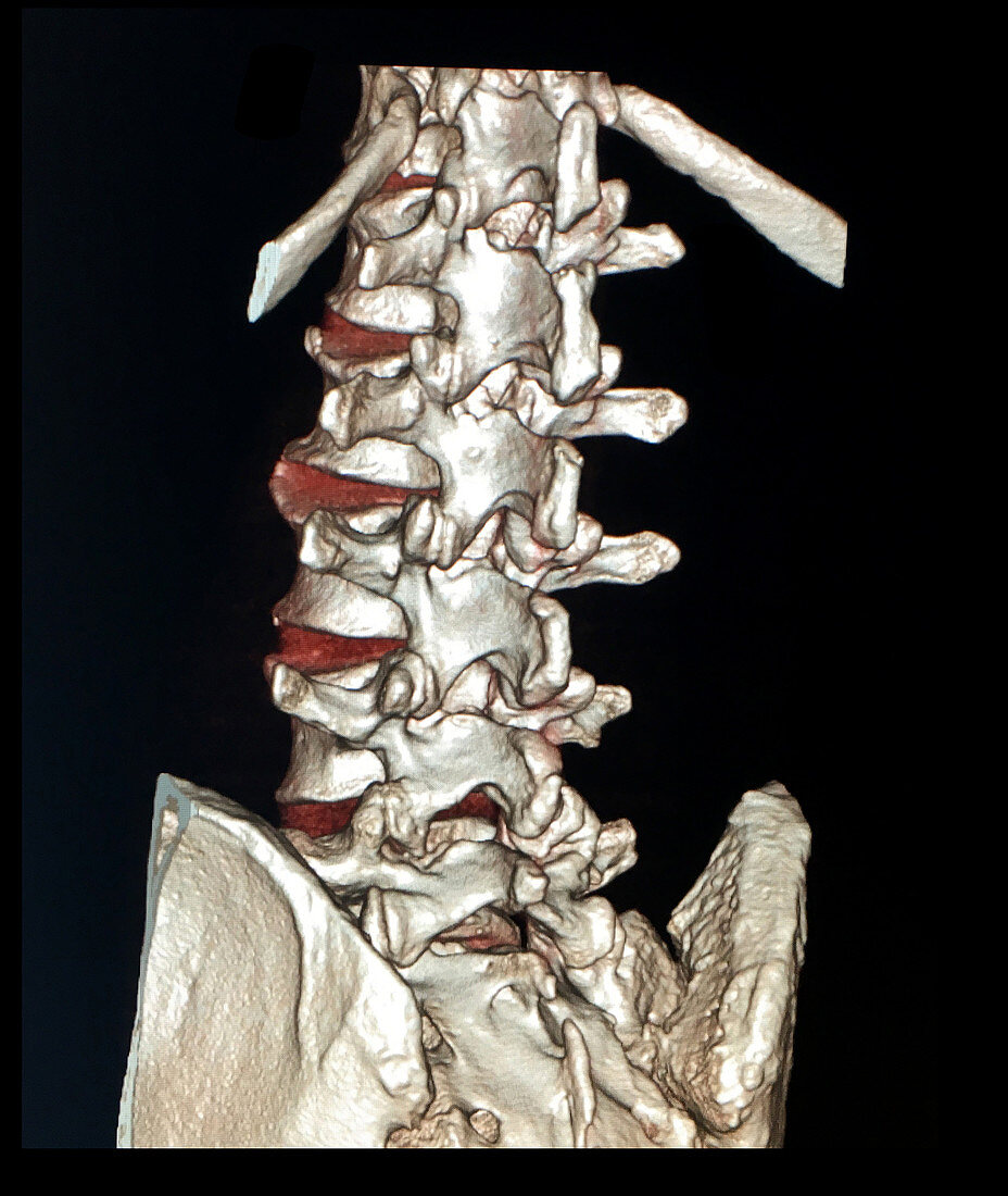 Reconstruction of Lumbar Spine, 3D CT
