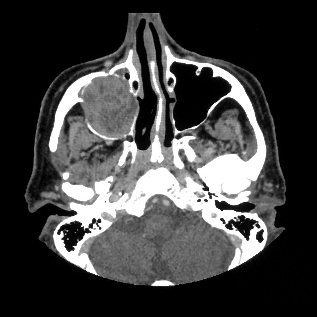 Ameloblastoma of Maxilla, CT