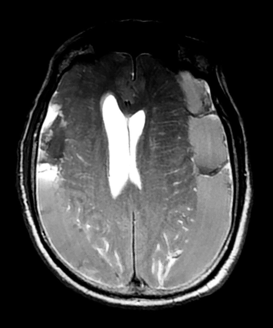 Chronic Bilateral Subdural Hematomas, MRI