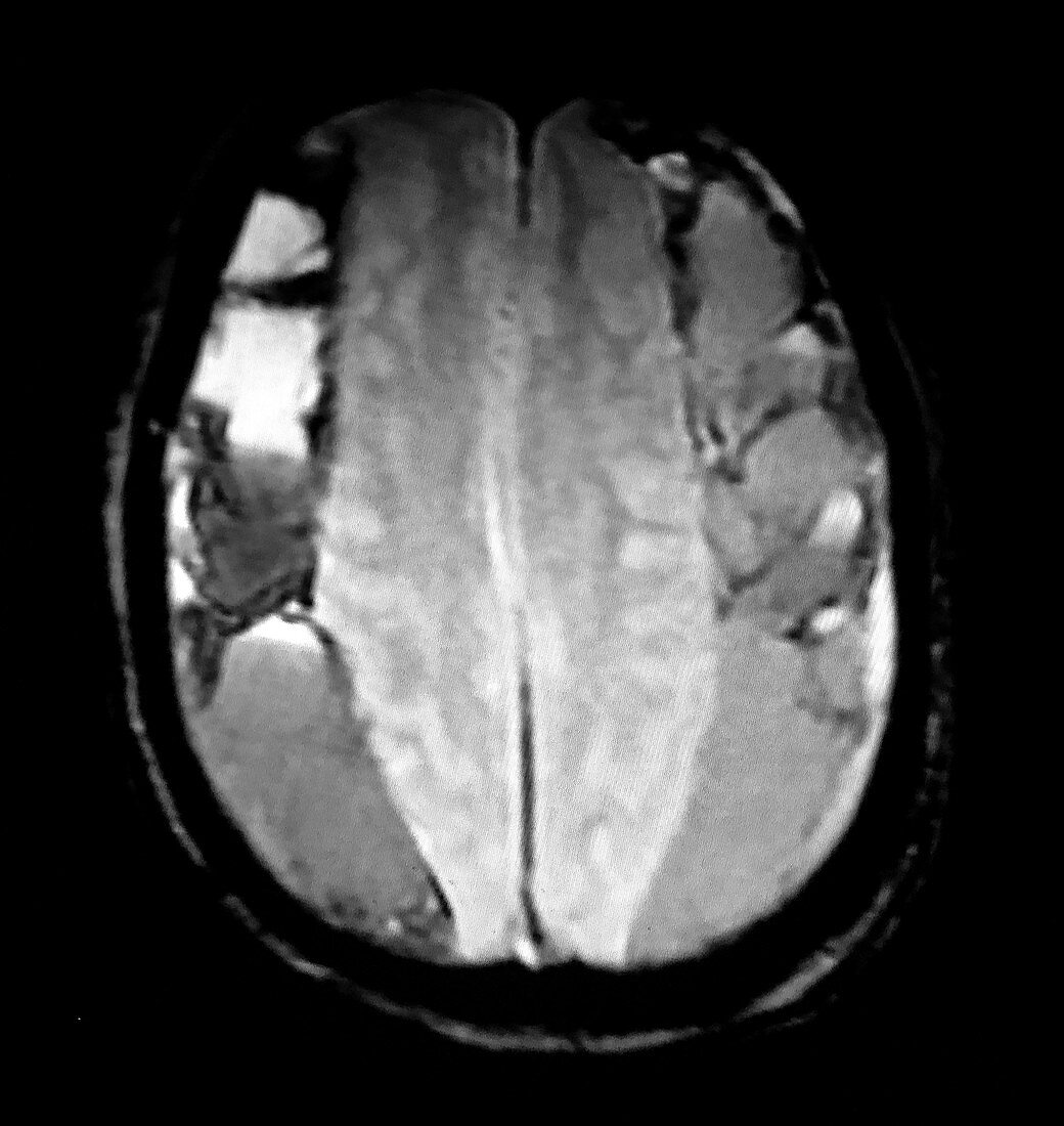 Chronic Bilateral Subdural Hematomas, MRI