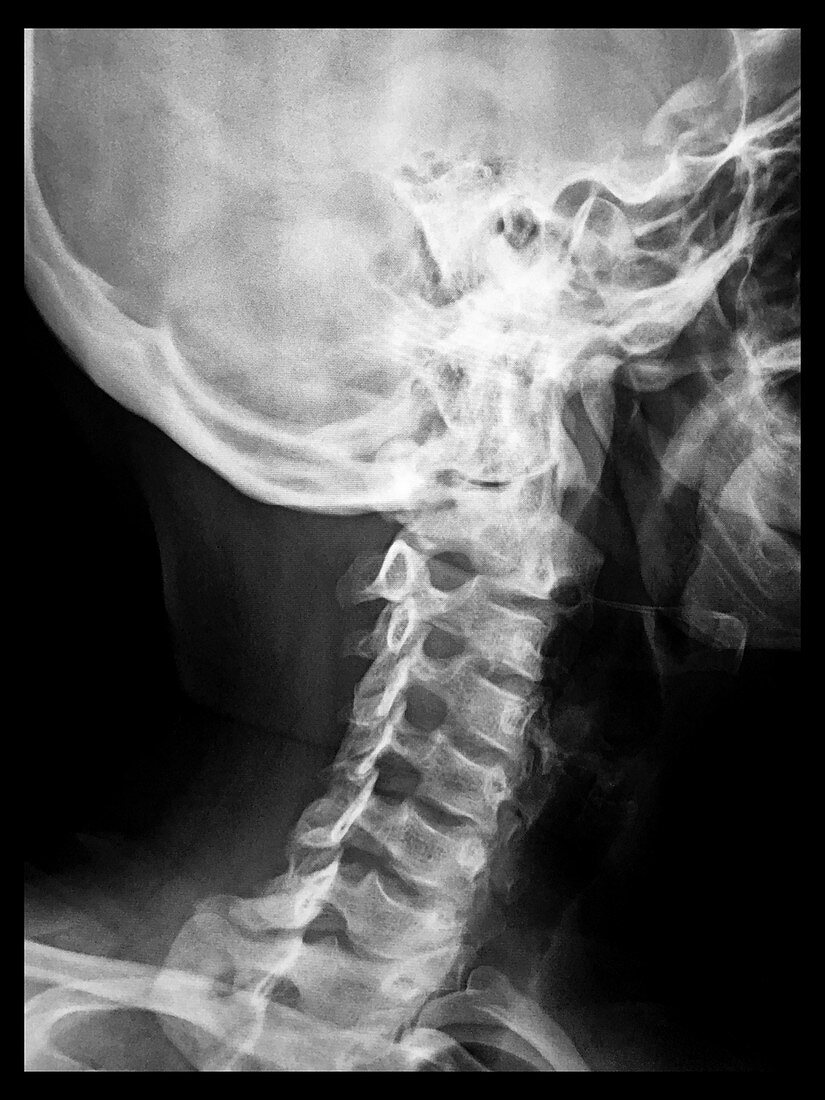 Normal Cervical Spine, X-ray