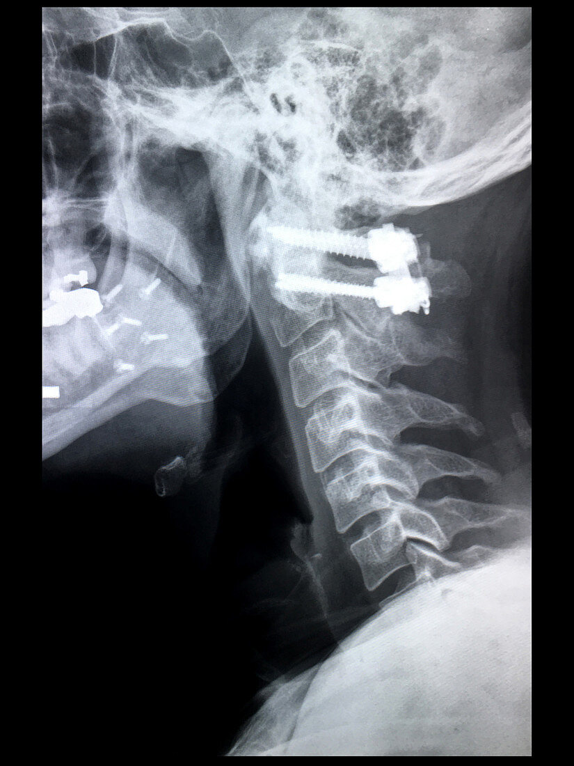 Post-operative Fixation of Cervical Spine, X-ray