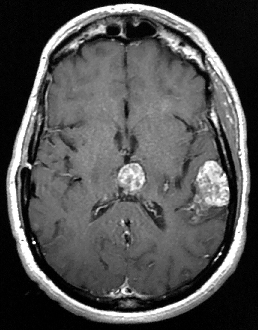 Imaging of Multiple Cavernous Malformations, CT