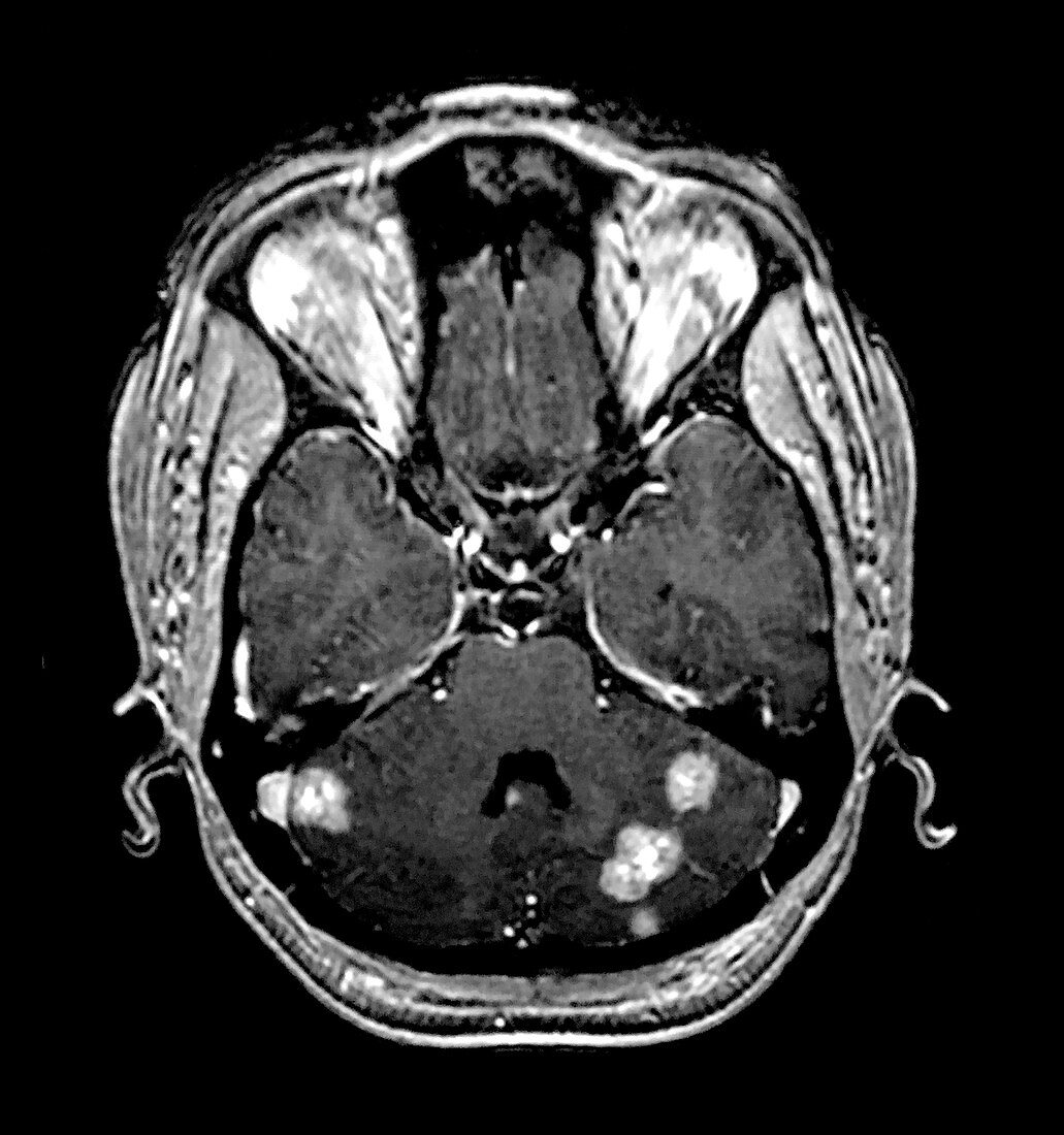 Colon Cancer Metastases, MRI