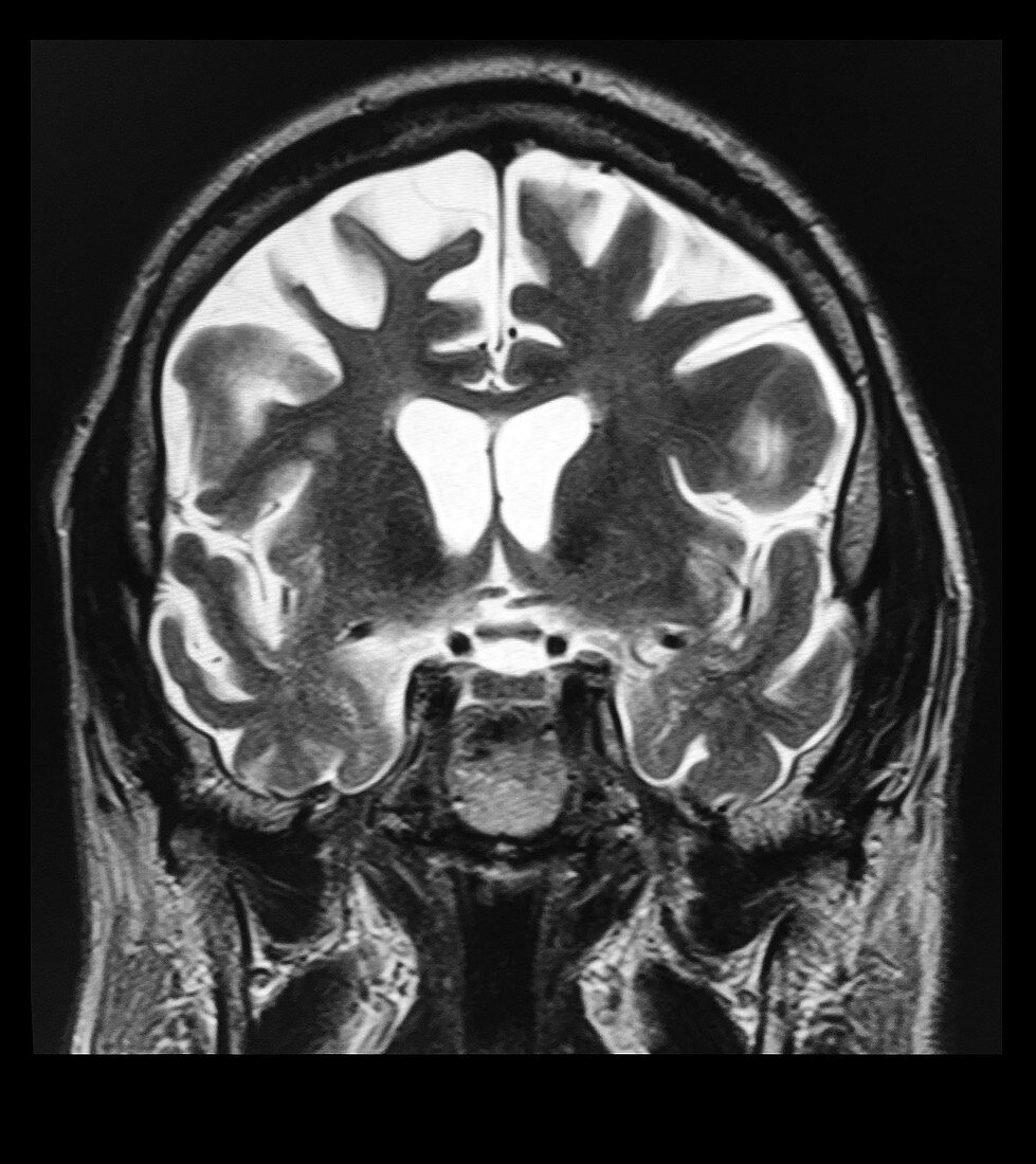 Frontal Temporal Dementia, MRI