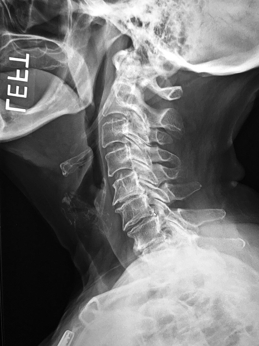 Eagle's Syndrome, X-ray