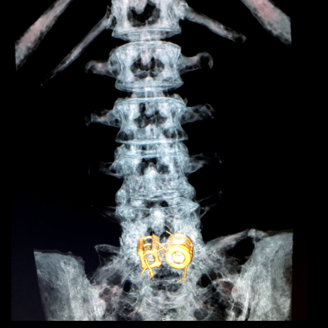 Lumbar Spine with Fusion Cages, 3D CT