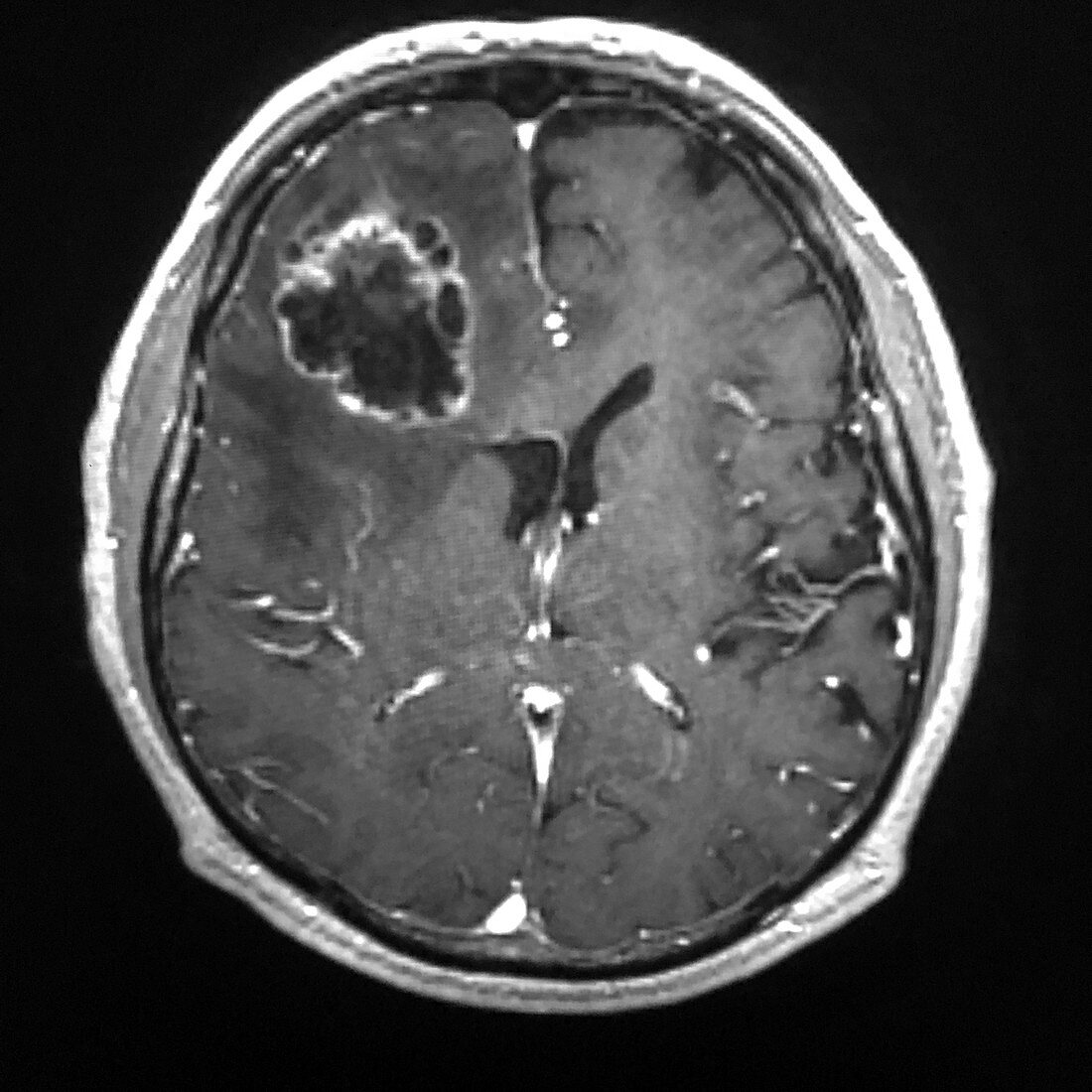 Frontal Lobe Glioblastoma, MRI