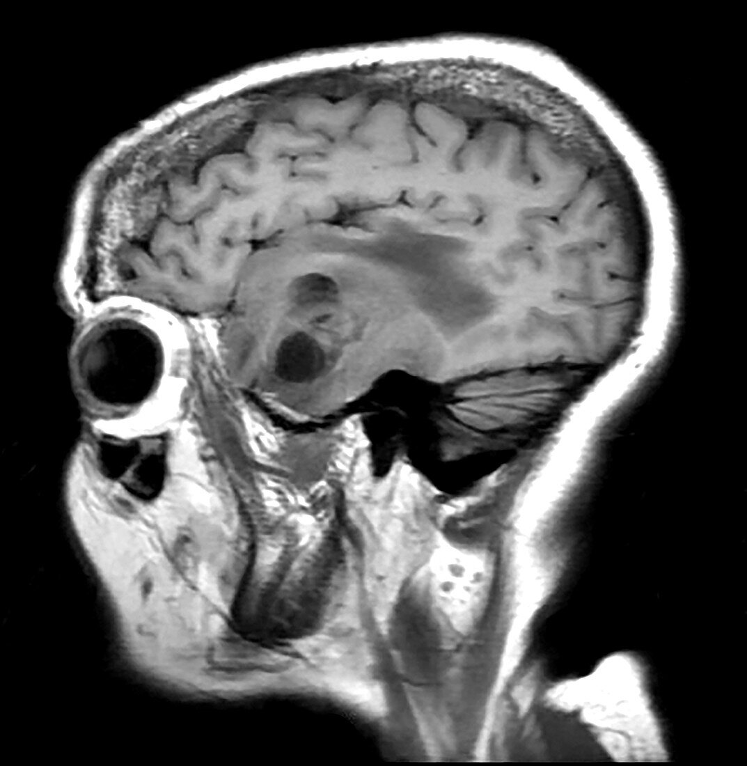 Temporal Glioblastoma, MRI