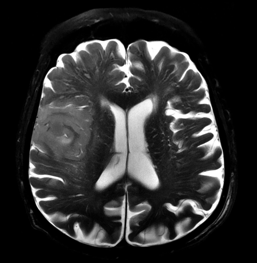 High Grade Glioma, MRI