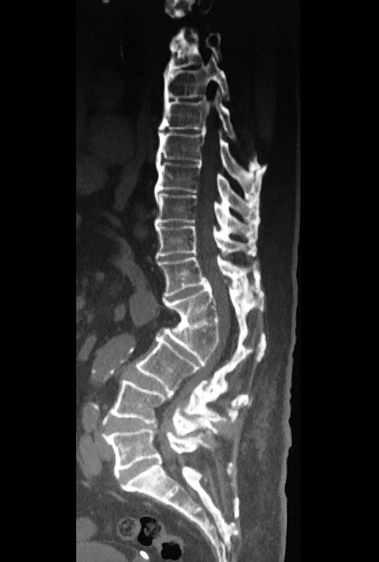 Severe Thoracic Lumbar Kyphosis, X-ray