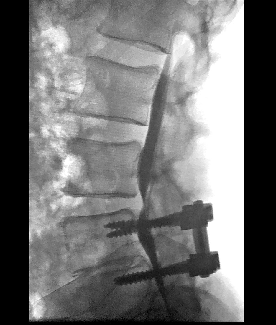 Lumbar Myelogram with Instrumentation, X-ray