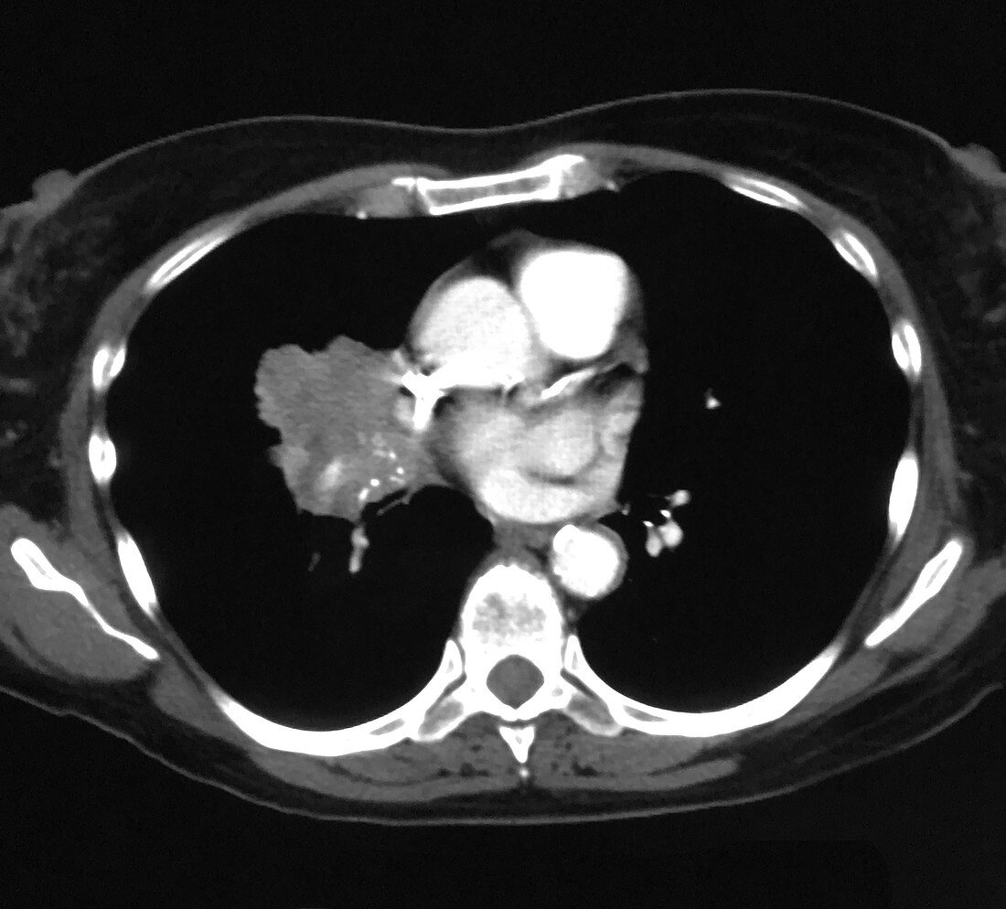 Lung Cancer, CT