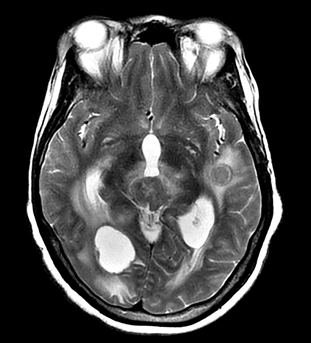 Metastatic Lung Cancer to Brain, MRI