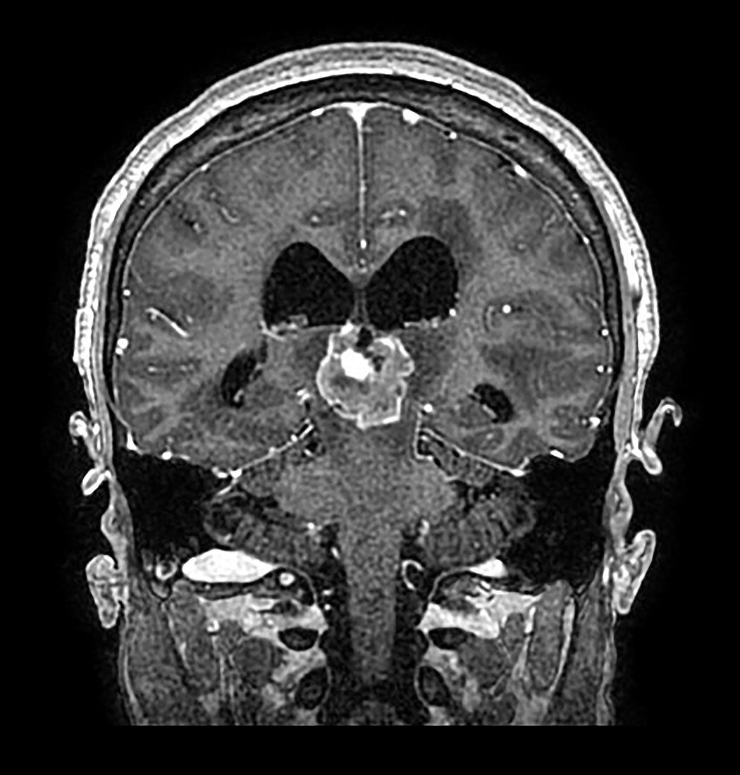 Metastatic Lung Cancer to Brain, MRI