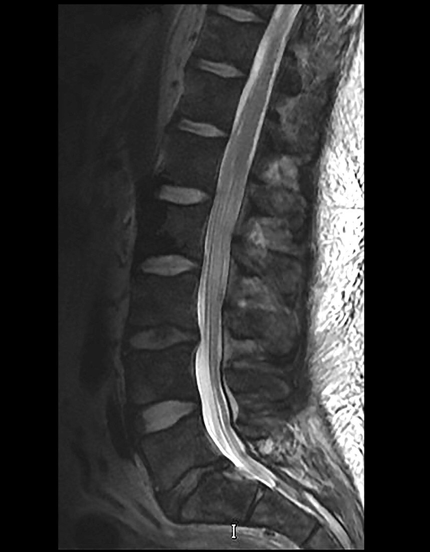 Lymphomatous Meningitis, MRI