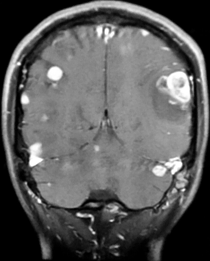 Melanoma Metastatic to Brain, MRI
