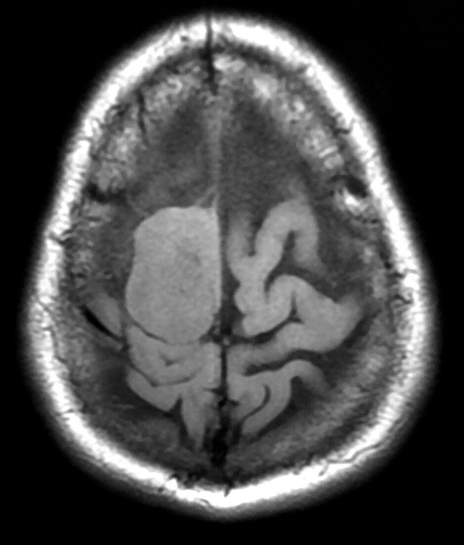 Meningioma at Vertex, MRI