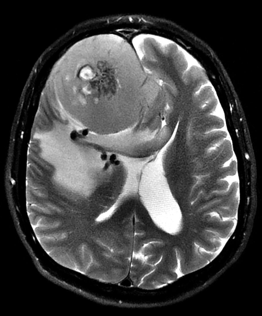Large Frontal Meningioma, MRI