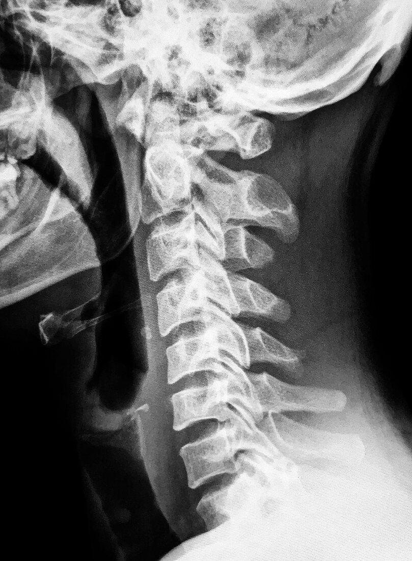 Normal Cervical Spine, X-Ray